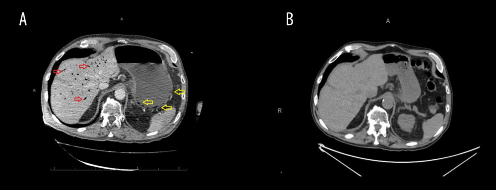 (A) CT scan at admission showing HPVG (red arrows) and gastric pneumatosis (yellow arrows). (B) CT scan on day 5 showing complete resolution of HPVG and gastric pneumatosis.