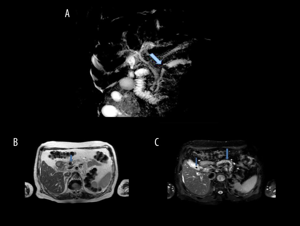 (A) Large pancreatic duct stone and stone dilation in MRCP. (B) Large pancreatic duct stone in MRI. (C) Calcified stone in gallbladder and dilated pancreatic duct in MRI.