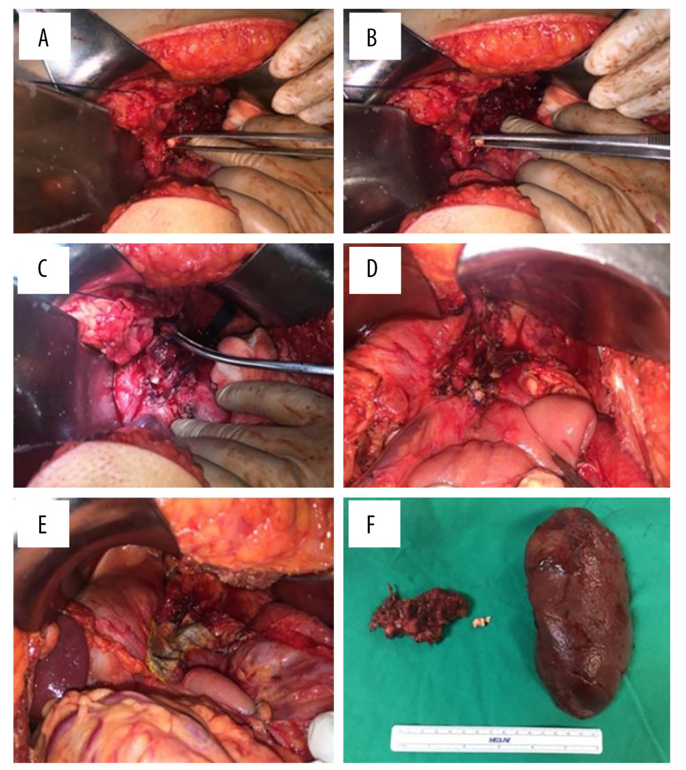 (A, B) Removal of the stone from the pancreatic duct. (C) Pancreatic duct ligation. (D, E) Suture and hemostatic sponge placement. (F) Pancreatic pseudocyst, stone, and spleen.