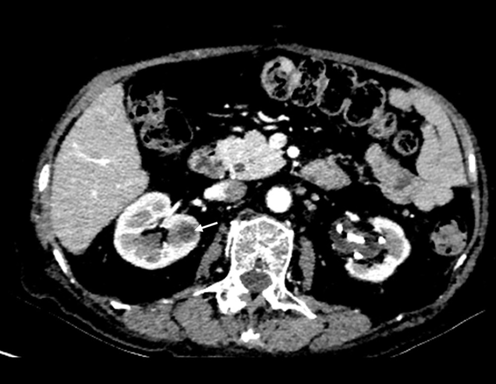 Characteristic renal computed tomography (CT) imaging. Low-density lesions on enhanced CT (white arrow).