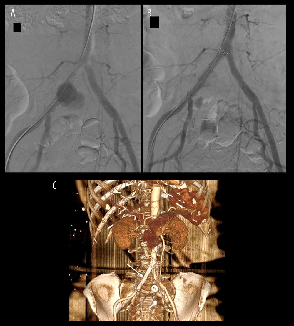 (A) Digital subtraction angiography (DSA) intraoperatively before covered stent graft placement showing ruptured bleeding of the common iliac artery aneurysm. (B) Post-implantation imaging after covered stent graft placement. (C) Contrast-enhanced computed tomography angiography (CTA) image after endovascular treatment (white arrows).
