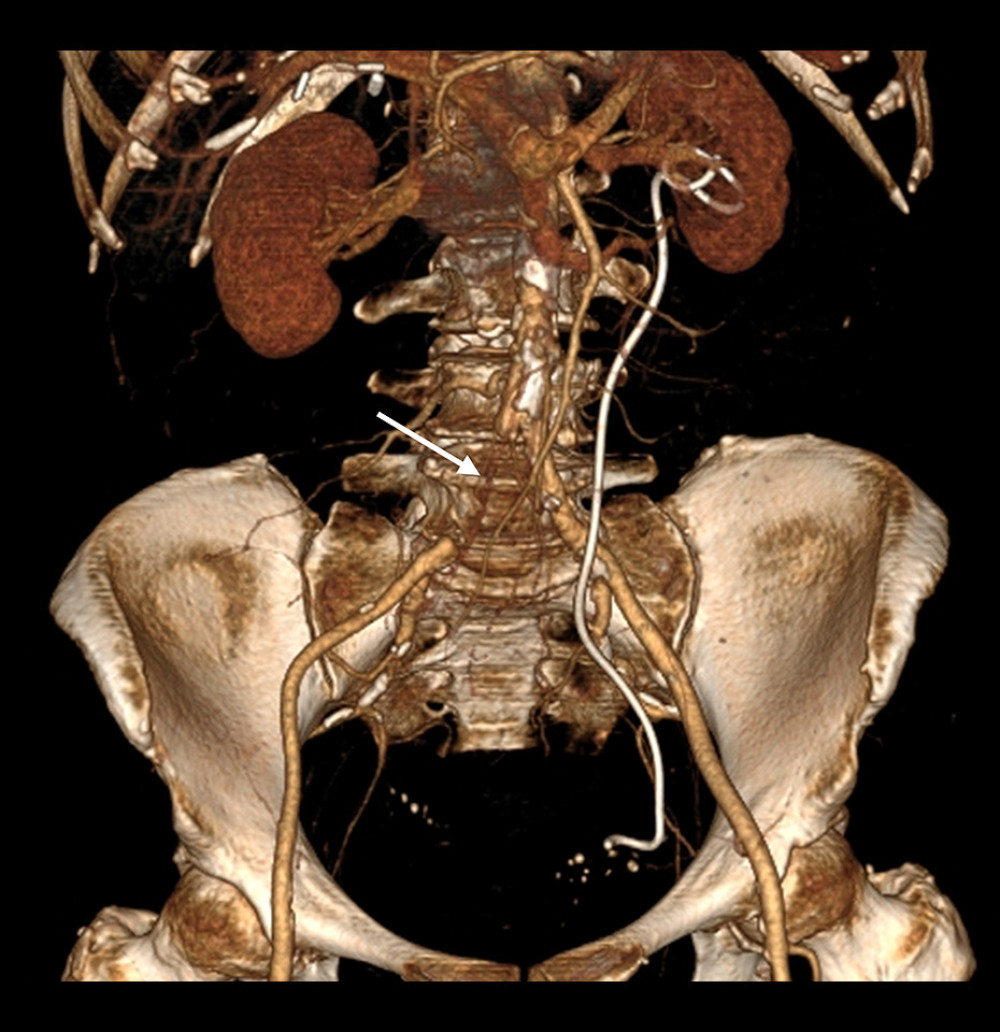 Contrast-enhanced computed tomography angiography (CTA) image after open surgery for the removal of the right iliac artery stent graft (white arrows).