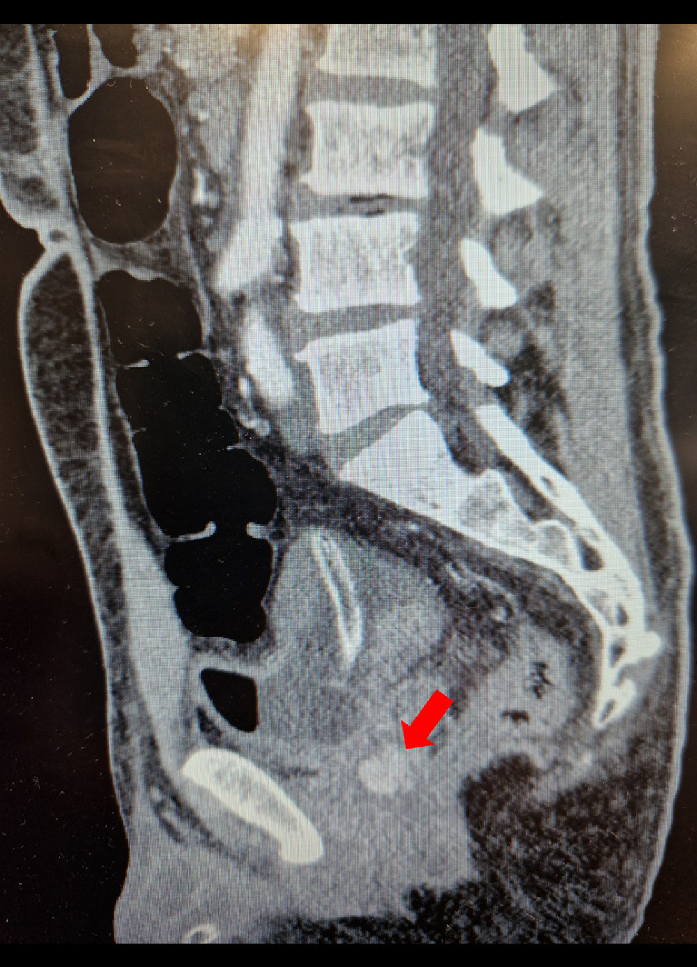 CT scan (sagittal) – pseudoaneurysm (arrow).