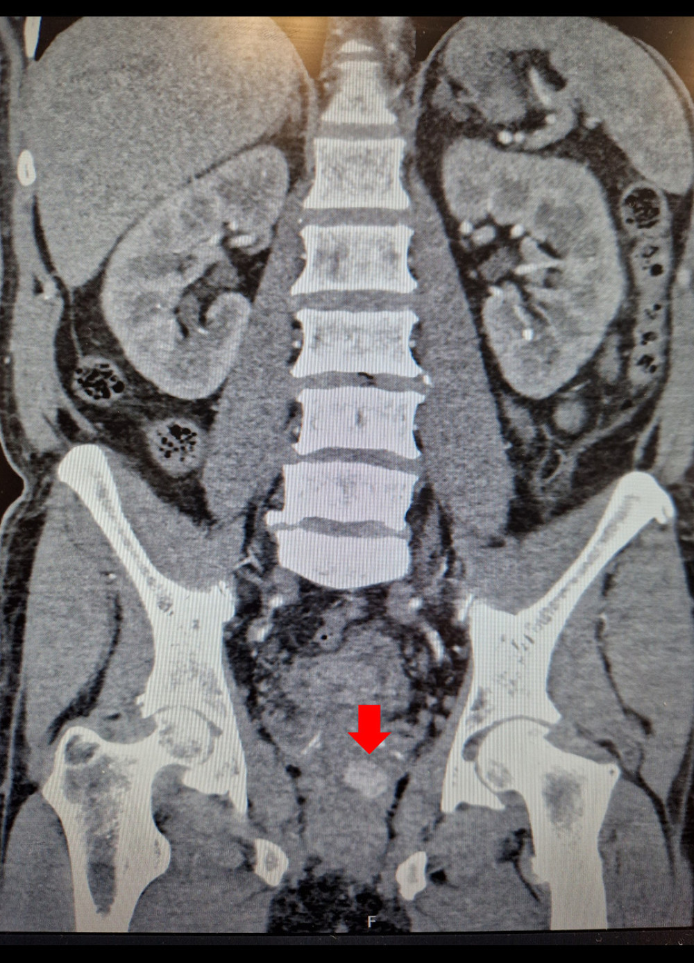 CT scan (coronal) – pseudoaneurysm (arrow).