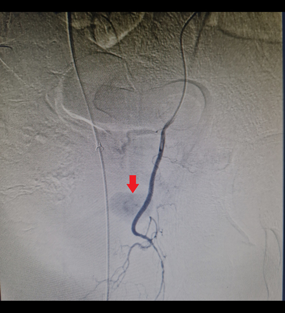 Angiography showing pseudoaneurysm (arrow).
