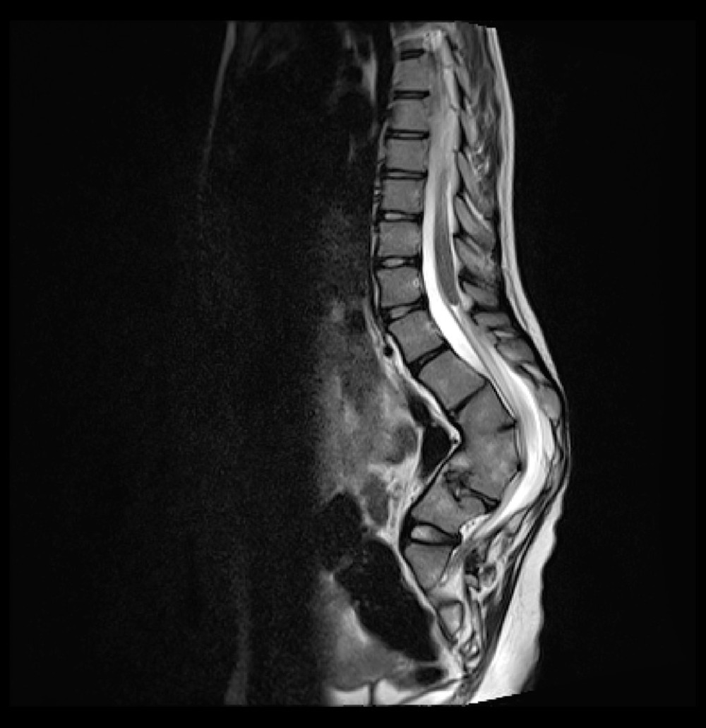 Lumbosacral spine magnetic resonance imaging (MRI) of the patient with diagnosis of caudal regression syndrome. Sagittal T2-weighted image shows several key findings: marked kyphotic curvature at the lumbar spine; anterolateral spinal fusion of L2 and L5; sacrum hypoplasia and coccyx agenesis. The conus medullaris terminates at the D11–D12 intervertebral disc level, featuring a rounded, non-filiform distal contour.