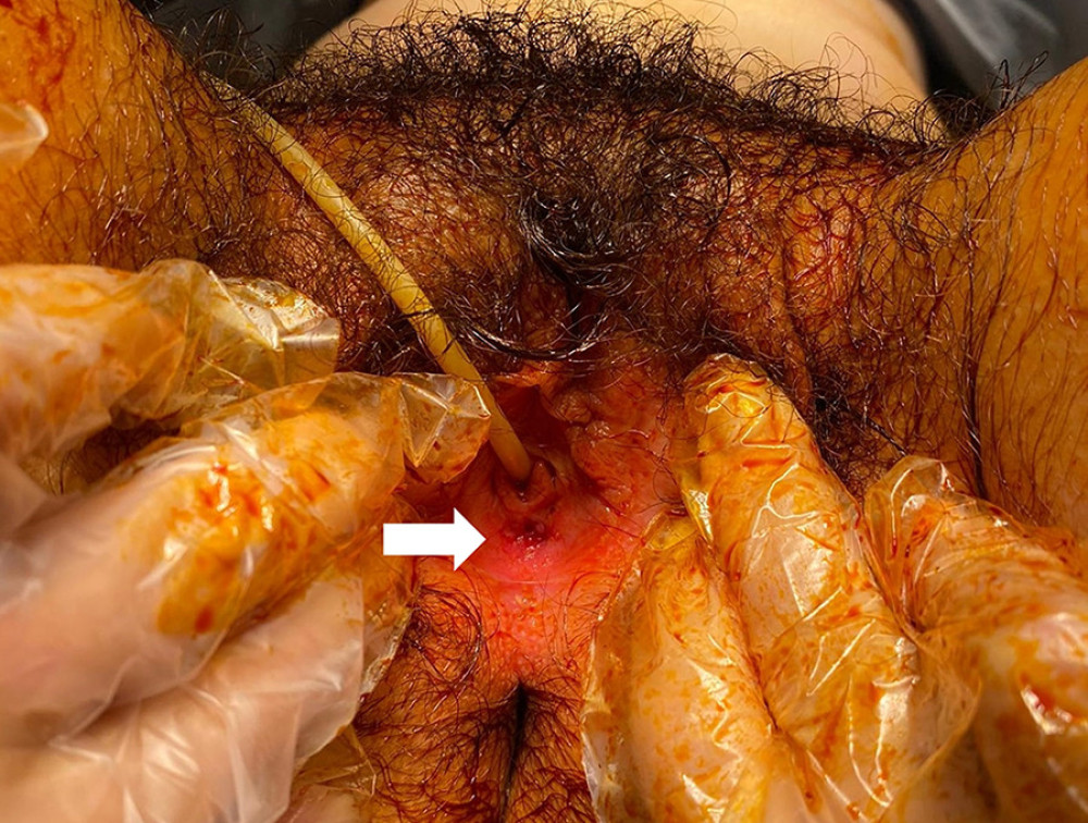 Pre-operative image of external genitals showing normal labia majora, minora, and urethra, with the absence of vaginal opening covered by a thick pink mucous membrane (indicated by the white arrow).