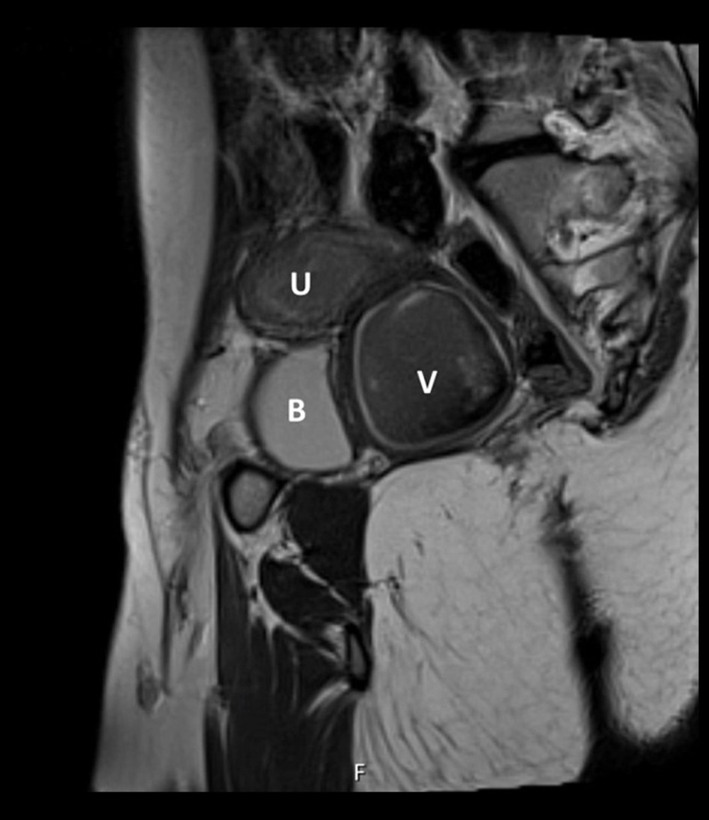 Magnetic resonance imaging of the pelvis at the patient’s initial presentation. Sagittal T2-weighted image obtained slightly right of the midline showing distal vaginal atresia, distended vagina due to hematocolpus (V), and slightly distended uterine cavity due to hematometra (U). (U – uterus; V – vagina; B– bladder).