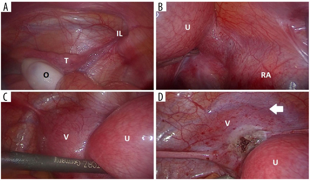 Laparoscopic view of internal reproductive organs. (A) Left adnexal region revealing ovary and tube fixed to the left abdominal wall, without connection with the uterus and round ligament with an abnormal path directly from the abdominal wall into the left inguinal canal. (B) Right adnexal region – adnexa transformed in retroperitoneal complex conglomerate. (C) Slightly enlarged uterus superiorly and on the right with distended vagina due to hematocolpus. (D) Laparoscopic view after the drainage of hematocolpus, a white arrow shows the utero-vesical reflection. (O – ovary; T – tube; IL – inguinal ligament/canal; U – uterus; RA – right adnexa; V – vagina).