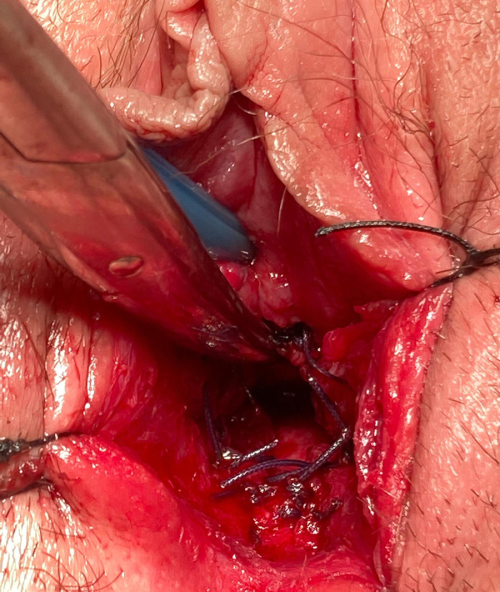 Surgical result at the end of pull-trough vaginoplasty procedure confirming the patency of the vagina.