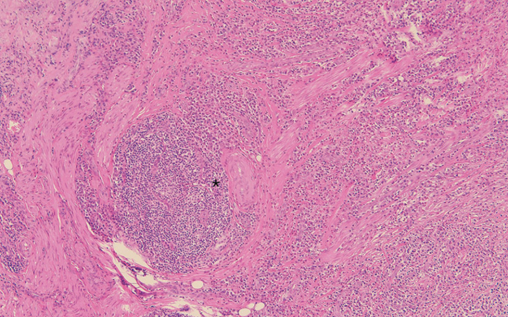 Findings of an excisional biopsy conducted in the right upper eyelid. Microscopy and Immunohistochemistry. Hematoxylin and eosin staining at 200× magnification showed inflammatory infiltration consisting of lymphoid follicles (asterisk), histiocytic cells, and eosinophils with eosinophilic abscess formation.