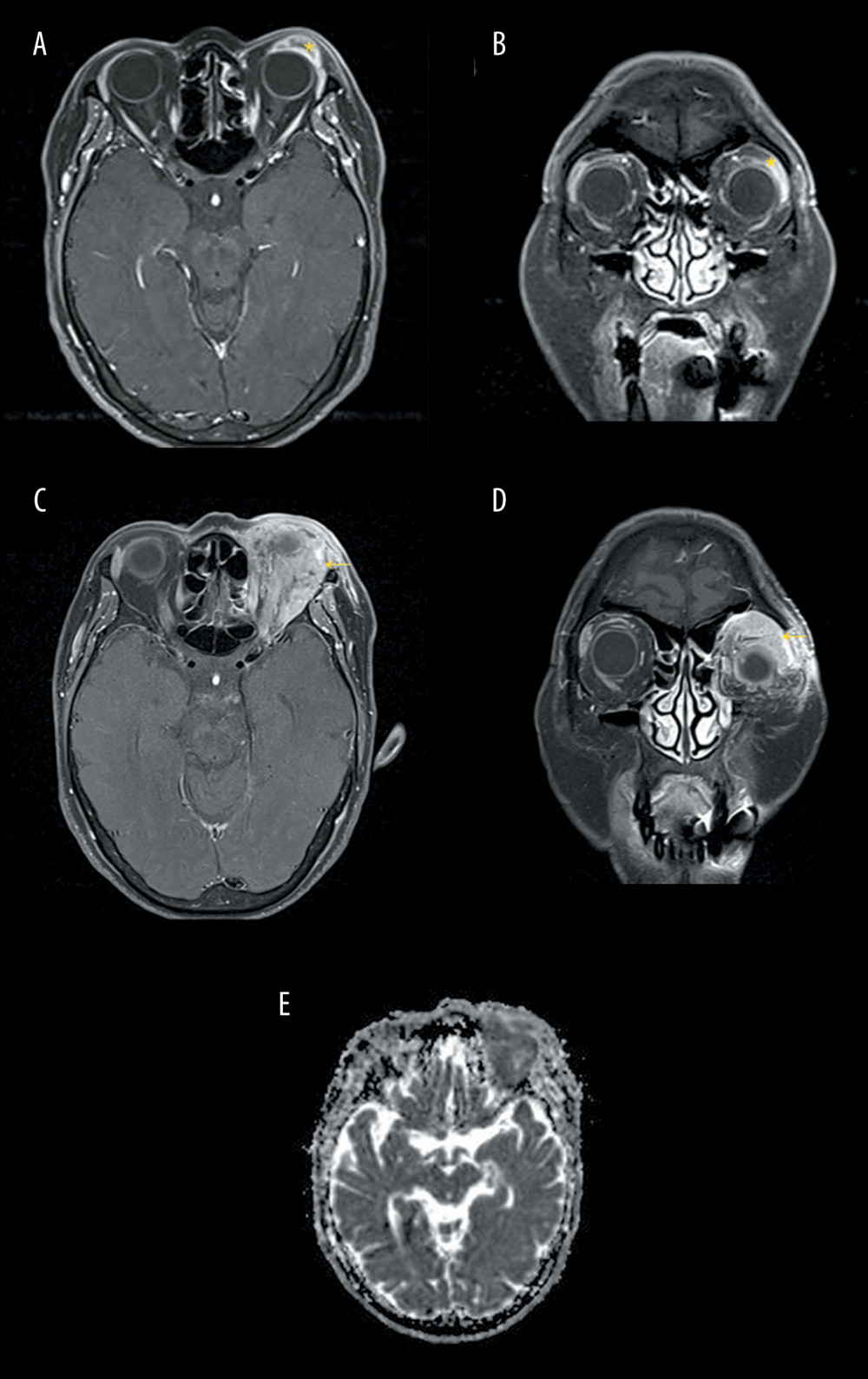 MRI images when first symptoms of left upper eyelid occurred and when malignancy was suspected. (A) Axial T1-weighted MRI and coronal T1 MRI (B) revealed a mass with peripheral enhancement. The size of the mass was 5×15 mm (yellow asterisk). Despite repeated treatments, the patient’s symptoms did not improve. (C) Axial T1-weighted MRI, and coronal T1 MRI (D) showed an increase in the size of the mass to 44×40 mm (yellow arrow), and a decrease in the apparent diffusion coefficient value (ADC value) to 0.67 (E).