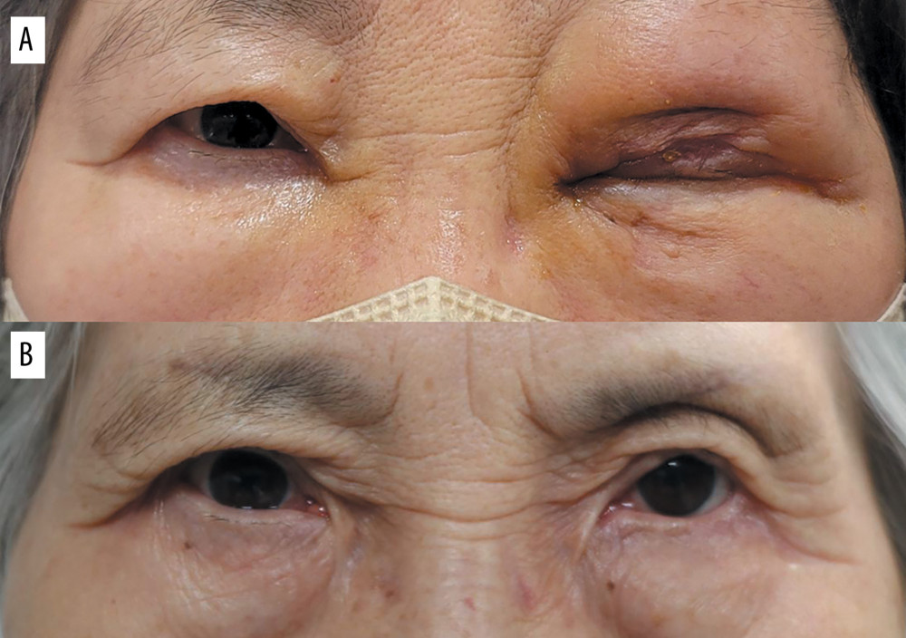 Facial photos when worsening and after chemotherapy. (A) Symptoms worsened, presenting with severe eyelid swelling, decreased vision, and positive relative afferent pupillary defect, suspecting compressive optic neuropathy. (B) After chemotherapy, swelling of the left upper eyelid improved due to dramatic reduction in the extent and size of the tumor.