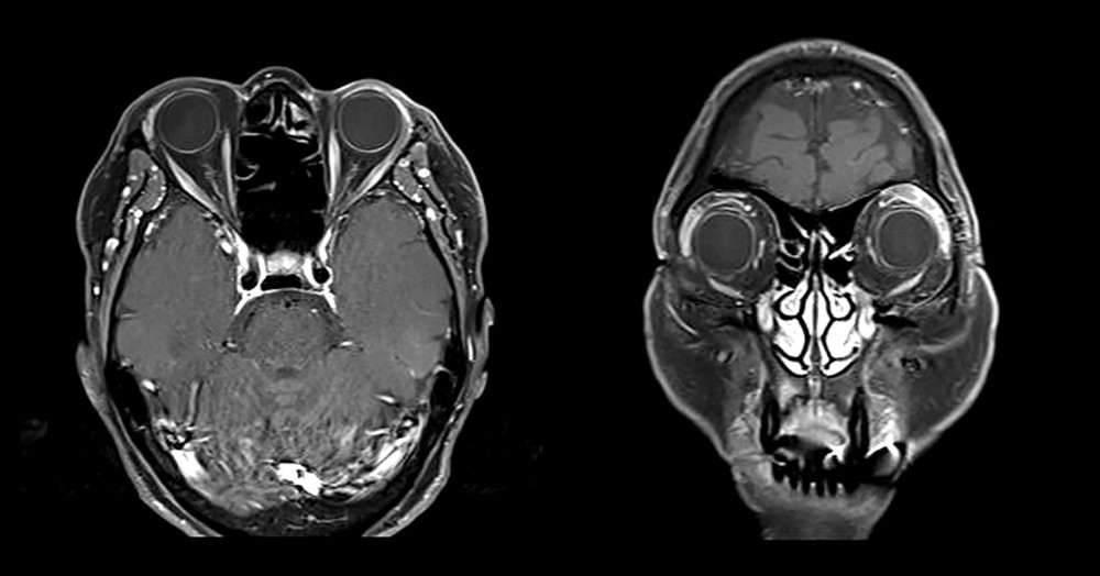 MRI images during follow-up after CVP chemotherapy. (A) After 6 months CVP chemotherapy, axial T1-weighted MRI and coronal T1 MRI (B) showed complete resolution of the previous lesions, and over 1 year of follow-up, the patient remained stable without recurrence of symptoms.