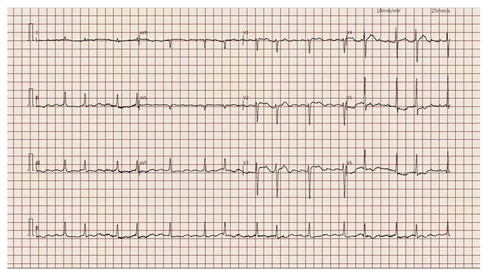 Electrocardiogram demonstrating atrial fibrillation, mild ST segment elevation in leads V3 and V4, and T-wave changes in leads II, III, aVF, V5, and V6.