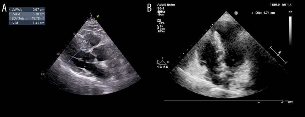 (A) Echocardiogram demonstrating left ventricular hypertrophy, with a septal thickness of 1.41 cm. (B) About 2 weeks after presentation, the echocardiogram demonstrated interventricular septal hypertrophy, with maximum septal thickness of 1.71 cm.