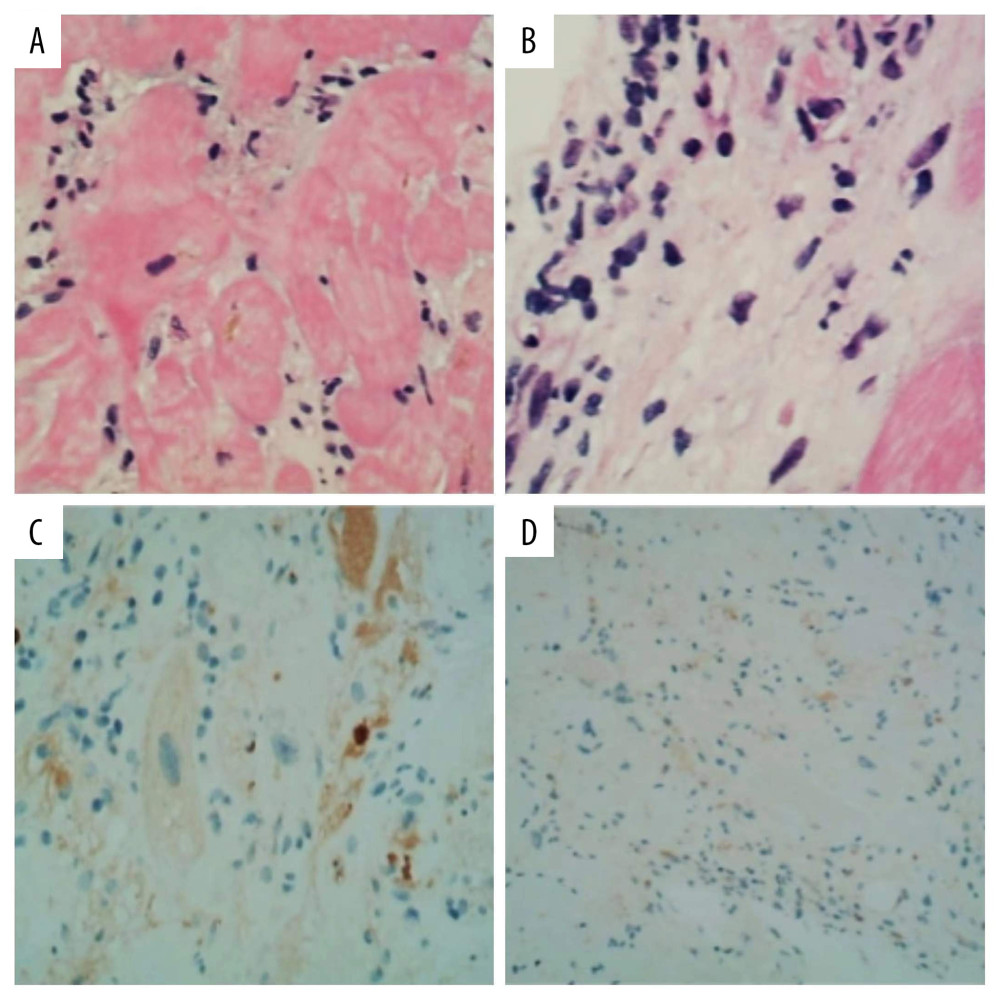 Histopathological specimen of biopsied myocardium demonstrating myopathic features: (hematoxylin and eosin stain)-scattered inflammatory cell infiltration with extensive interstitial fibrosis and focal mucous degeneration (A, B). Interstitial expression of Kappa foci and no Lambda and amyloid A protein can be seen in immunohistochemistry (C, D).