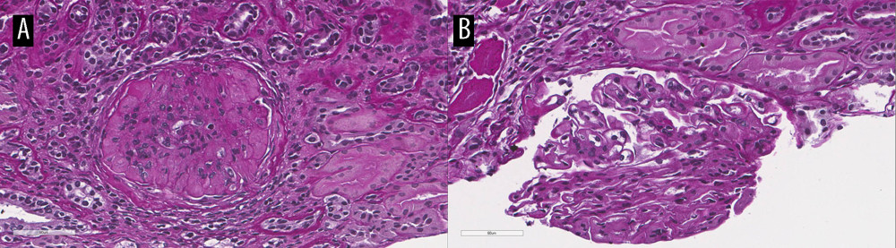Image (A) demonstrates an abundant deposition in the mesangium and globally in the subendothelial zone. Image (B) shows duplication of the glomerular basement membranes.