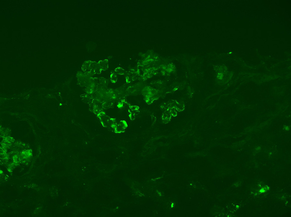 2+ mesangial staining for immunoglobulin A.