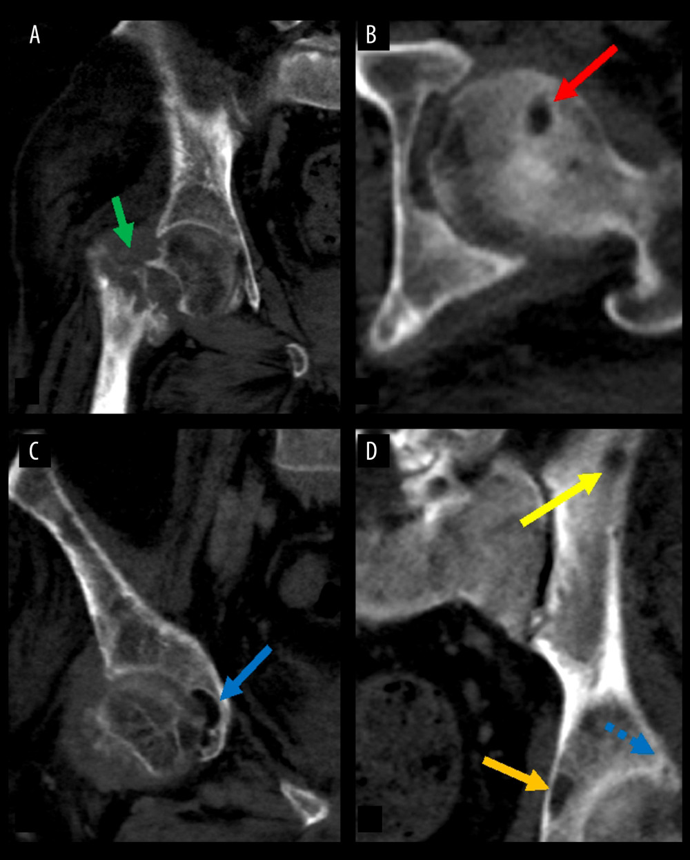 Radiologic findings of multiple osteolytic lesions on CT-imaging. (A) A coronal view of a subacute-to-chronic-appearing, displaced, angulated, pathologic fracture with associated ill-defined lytic lesions (solid green arrow); (B) An axial view of a lucent lesion centered at the left femoral head (solid red arrow); (C) A coronal view of a similar lytic lesion at the anterior right acetabulum (solid blue arrow); (D) A coronal view of a similar lucent lesion in the left iliac bone (solid yellow arrow), in the left acetabulum (solid orange arrow) and left posterior acetabular bone (dotted blue arrow).