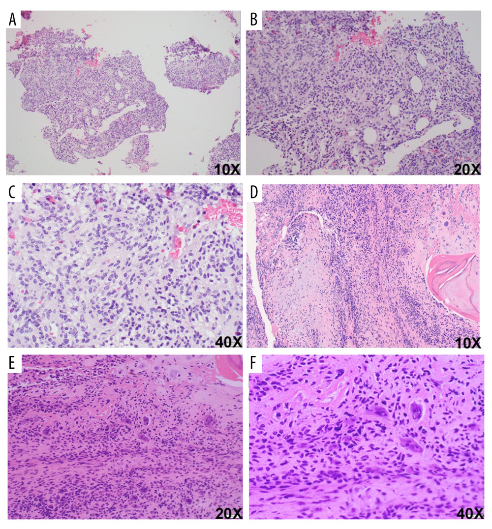 Histologic findings of the right femur lesion. (A–C) Representative section of the right proximal femur specimen shows a hypercellular lesion composed of small blue cells with oval-to-spindled morphology infiltrating into the native trabecular bone, 10× (A), 20× (B), and 40× (C). (D–F) Representative section of the lesion admixed with abundant multinucleated giant cells, 10× (D), 20× (E), and 40× (F).