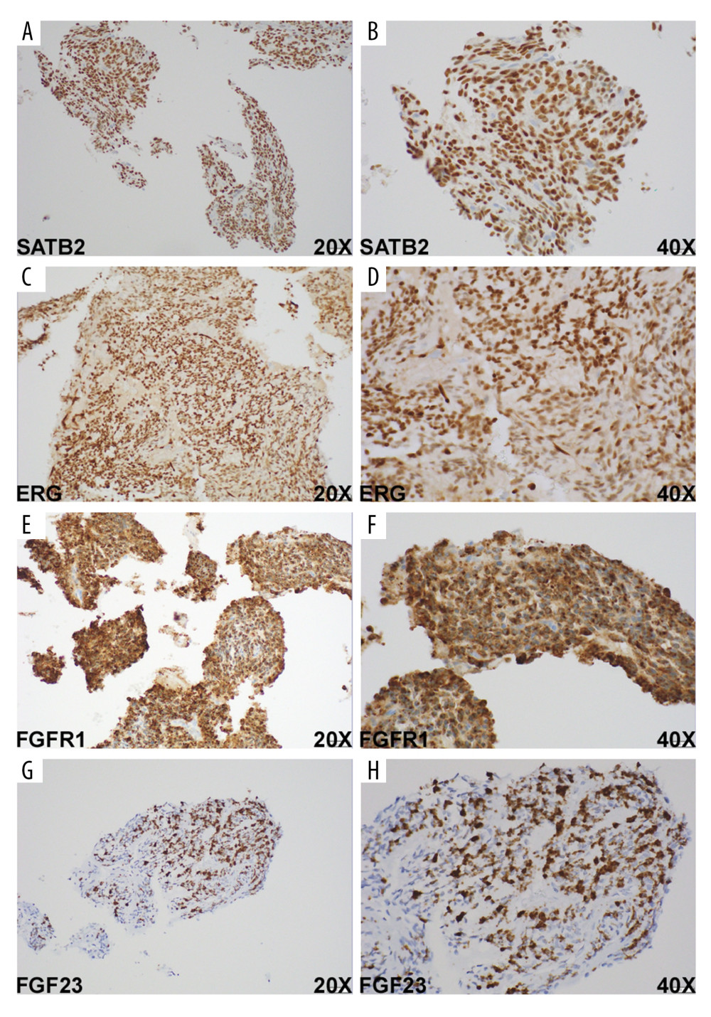 Immunostain findings of the right femur lesion. (A, B) The tumor cells are positive for SATB2 (nuclear staining), 20× (A) and 40× (B). (C, D) The tumor cells are positive for ERG (nuclear staining), 20× (C), and 40× (D). (E, F) The tumor cells are positive for FGFR1 (cytoplasmic and perinuclear staining), 20× (E), and 40× (F). (G, H) In situ hybridization (ISH) shows the tumor cells are positive for FGF23 (cytoplasmic and nuclear staining), 20× (G), and 40× (H).