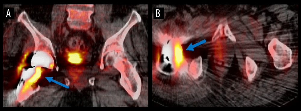 Radiologic findings of multiple osteolytic lesions on positron emission tomography computed tomography (PETCT) imaging. PET-CT scan after surgery shows interval right total hip replacement surgery with increased FDG (fluorodeoxyglucose 18F) radiotracer uptake at the medial aspect of the right femoral stem hardware (blue arrow) and less intensely in the surrounding soft tissues, consistent with inflammatory postsurgical changes. (A) Coronal orientation and (B) axial orientation.