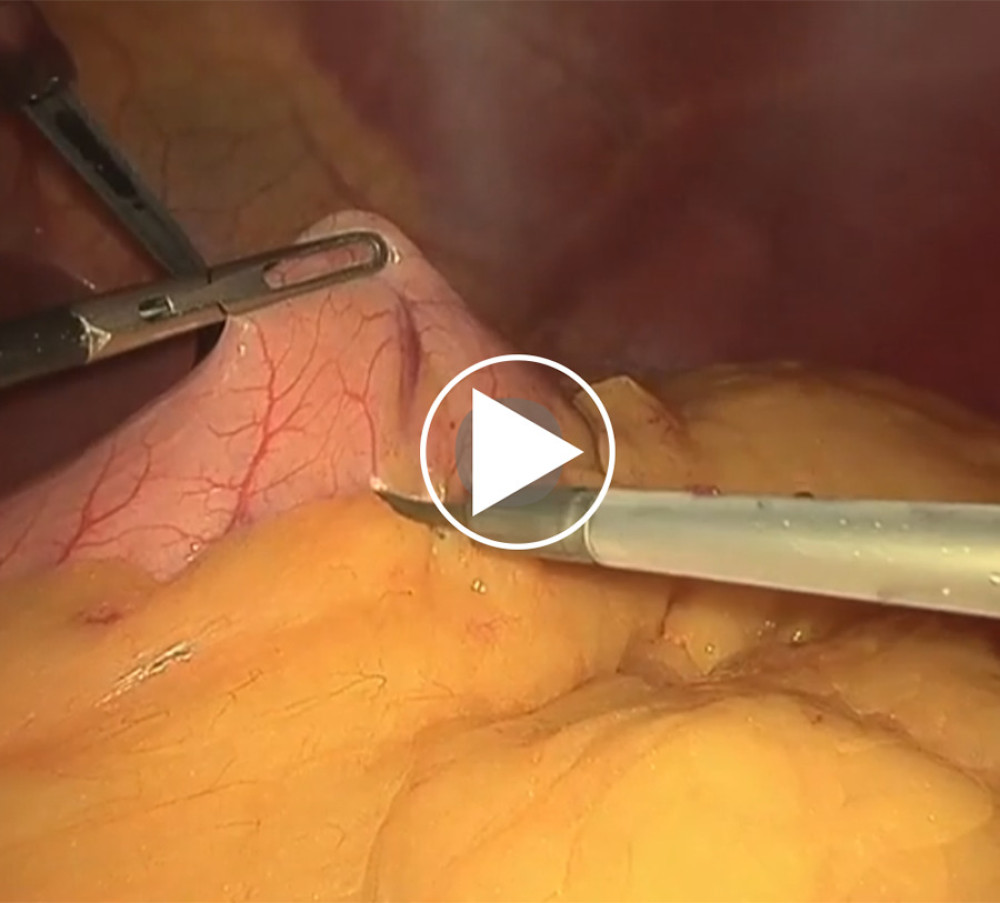 The video shows the procedure described in the article: sleeve gastrectomy with staple line oversewing. Pneumoperitoneum was performed with a Veress needle in the Palmer’s point. Four-trocar technique was used. The procedure started by division of gastroepiploic vessels starting until 5 cm from the pylorus. Dissection continued toward the gastric fundus with division of short gastric vessels until visualization of the left crus of the diaphragm. A calibrating bougie (38F) was placed. A linear stapler was placed from the trocar at the right upper quadrant. Traction from the left trocar is important to clear the fundus from the gastric tube. Staple-line reinforcement is done by oversewing using continuous V-Loc 3/0 taking only the serosal layer. The methylene blue test was done. Hemostasis was achieved by bipolar electrocoagulation. The transected stomach was removed via a port on the left flank.