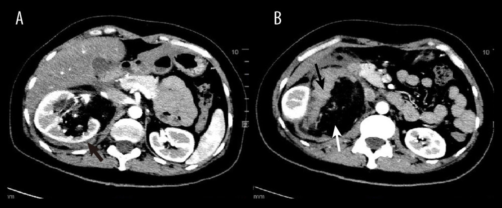 Contrast-enhanced CT image of case 1. (A) CT images show right perinephric hemorrhage (black arrow). (B) CT images show a large heterogeneously fat (white arrow) and soft-tissue mass (black arrow), which was confirmed to be angiomyolipoma by pathologic examination.