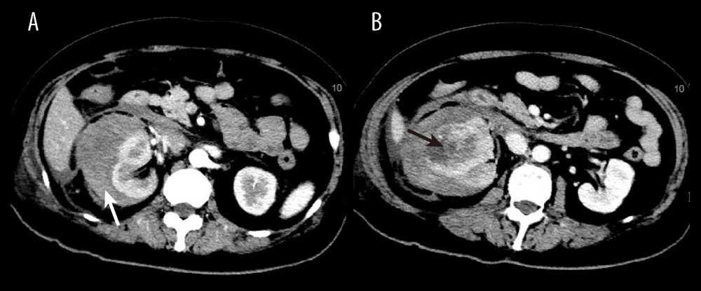 Contrast-enhanced CT image of patient 2. (A) CT image show a large right perirenal hematoma (white arrow). (B) CT image shows a heterogeneously enhancing lesion in the right kidney (black arrow), which was confirmed to be clear cell RCC by pathologic examination.