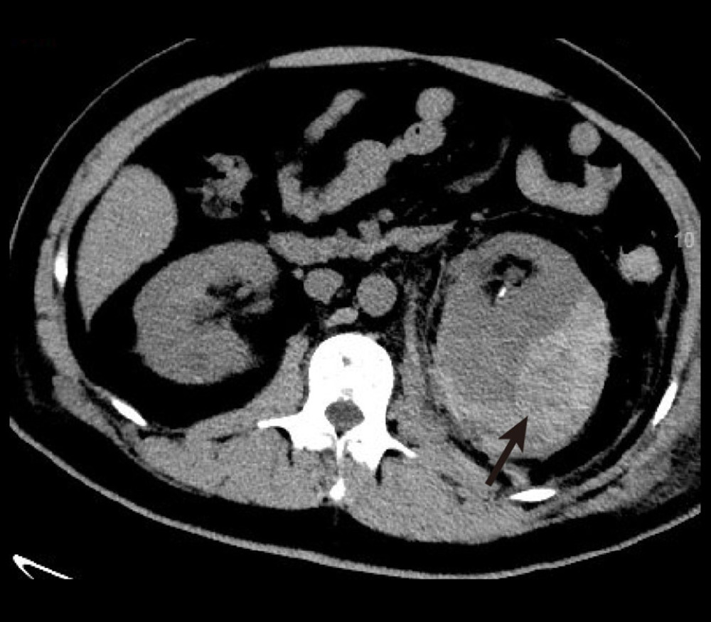 Noncontrast CT in patient 3 shows subcapsular hematoma of the left kidney. No clear cause was found, and surgery confirmed clear cell RCC.