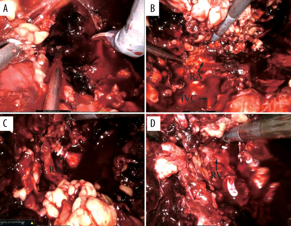 Intraoperative images of the right kidney. (A) Opening the Gerota’s fascia revealed many hematomas. (B) Follow the inferior vena cava (IVC) and find the right renal artery (RA). (C) Right renal artery was clipped by Hem-o-lok. (D) After disconnecting the right renal artery, the right renal vein (RV) can be seen by further dissection down.
