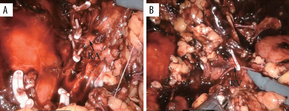 Intraoperative images of the left renal. (A) The kidney was pushed ventrally, and the left renal artery (RA) was searched for in the dorsomedial midpart of the kidney. (B) After the left kidney is flipped, the left kidney is pulled by the left renal vein (RV).