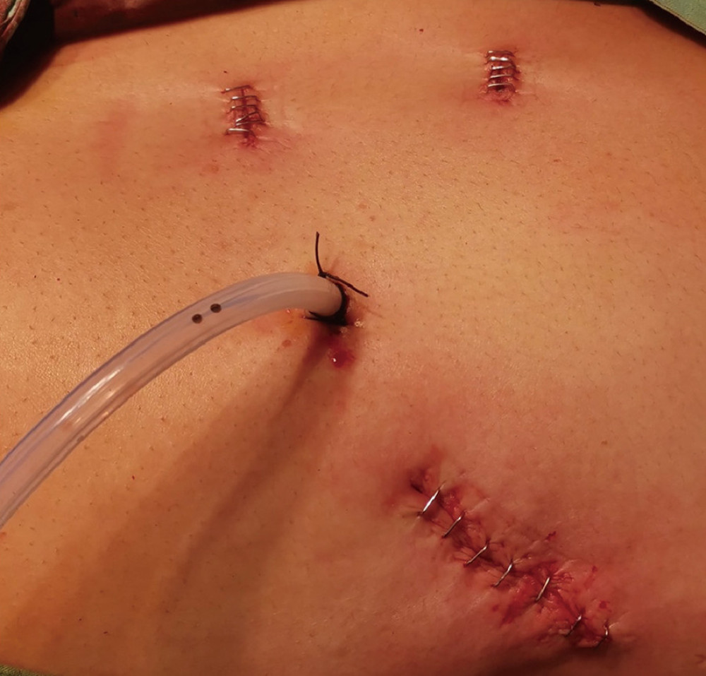 Pictures of the postoperative incision of the patient.