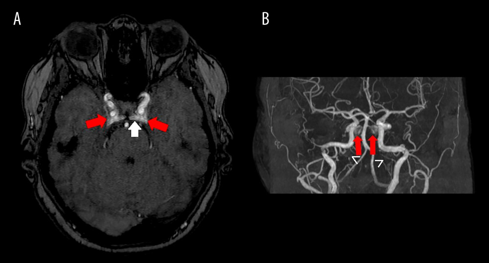 Initial axial (A) and 3D reconstruction (B) from 3D time-of-flight magnetic resonance angiography showing bilateral arterial flow in cavernous sinuses (red arrows), intracavernous sinus (white arrow), and inferior petrous sinus (arrowheads), suggesting bilateral dural carotid-cavernous fistulae.