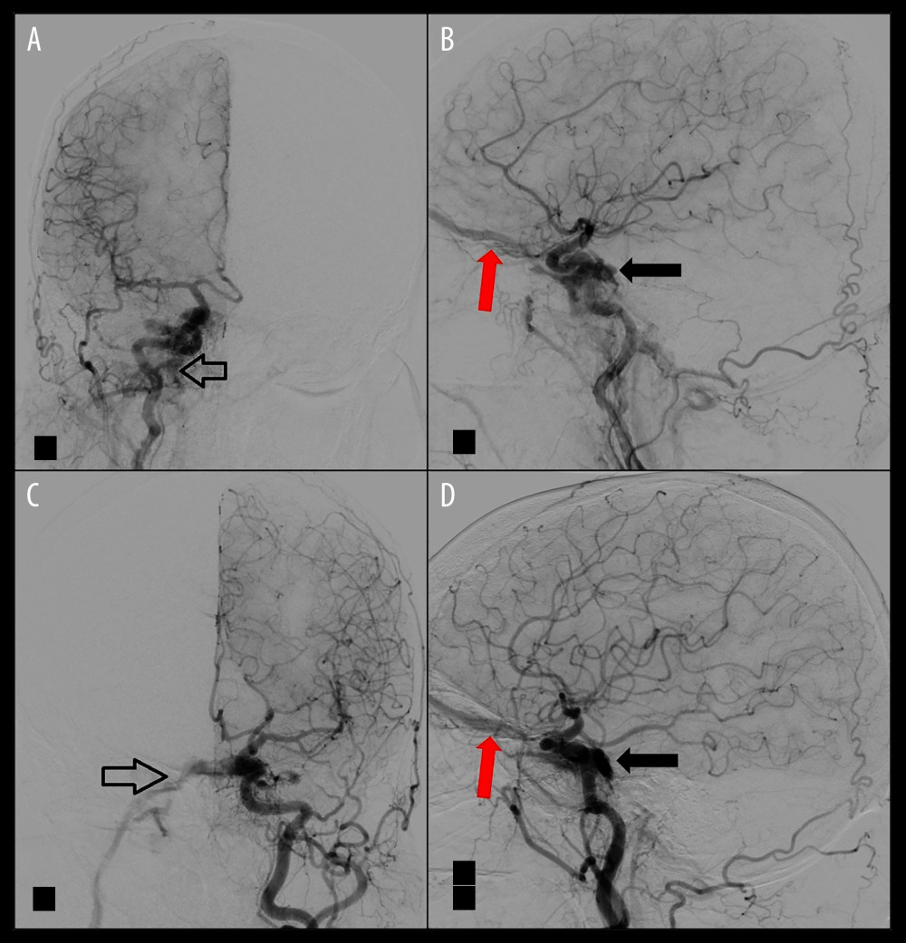 Digital subtraction angiogram confirming bilateral indirect Type-D carotid-cavernous fistulae (black arrows) with feeding arteries from intracavernous internal carotid artery branches and meningeal external carotid artery branches, draining bilaterally to ophthalmic veins (red arrows), and the inferior petrous sinus (empty arrows), on the right (A, B) and left (C, D) side.