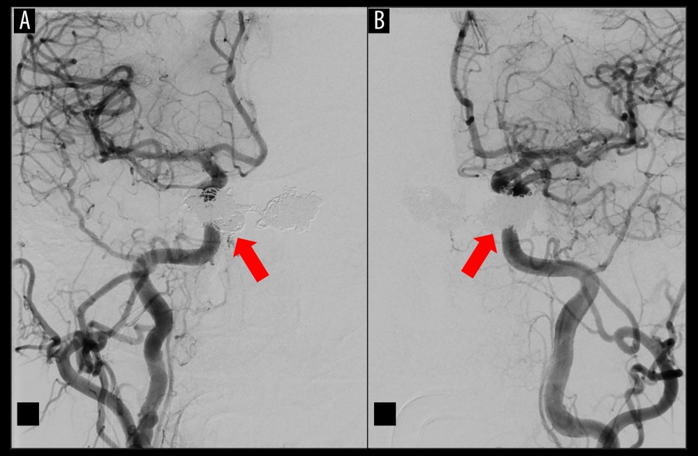 (A, B) Immediate post-coiling digital subtraction angiogram demonstrating no residual fistula following coil embolization of right and left cavernous sinuses (red arrows).
