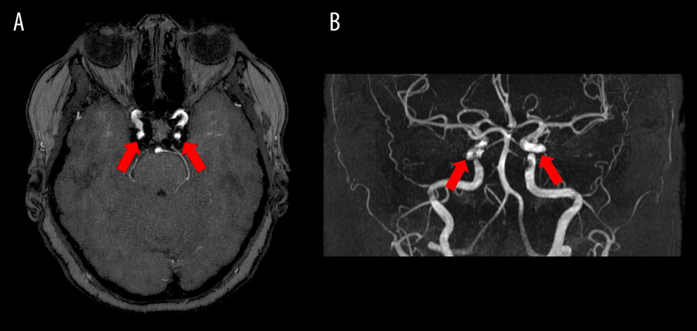Seven-month follow-up axial (A) and 3-dimensional reconstruction (B) 3-dimensional time-of-flight magnetic resonance angiography demonstrating stable occlusion of the bilateral indirect carotid-cavernous fistulae.