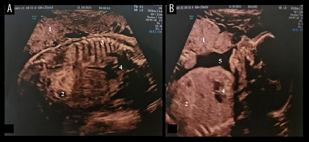 (A, B) Transabdominal ultrasound of the fetus at 22 weeks, showing a hyperechoic bowel and dilated loop. 1, Placenta; 2, dilated intestinal loops; 3, vertebral column; 4, heart; 5, amniotic fluid.