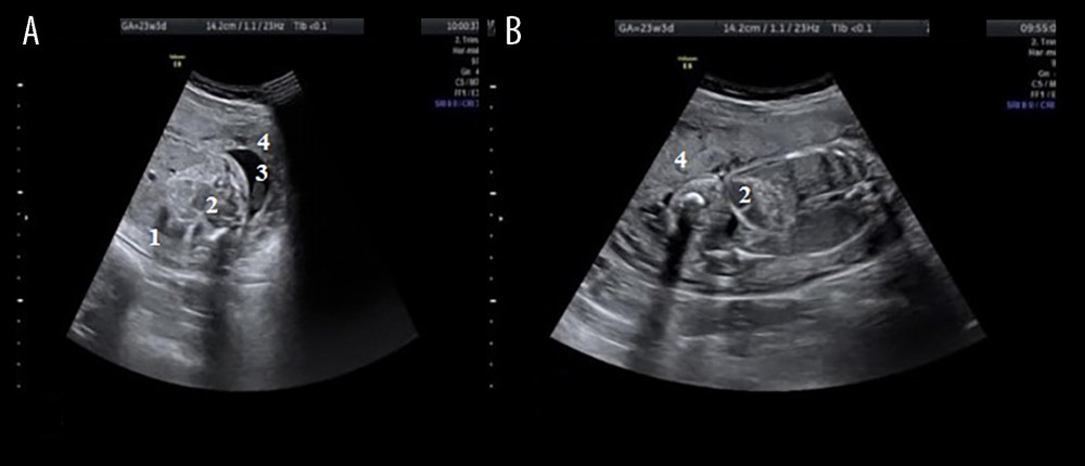 (A) Transabdominal ultrasound of the fetus, aged 23-weeks and 3-days, showing a hyperechoic bowel. (B) Dilated loop. 1, section through the abdomen; 2, dilated intestinal loops; 3, amniotic fluid; 4, placenta.