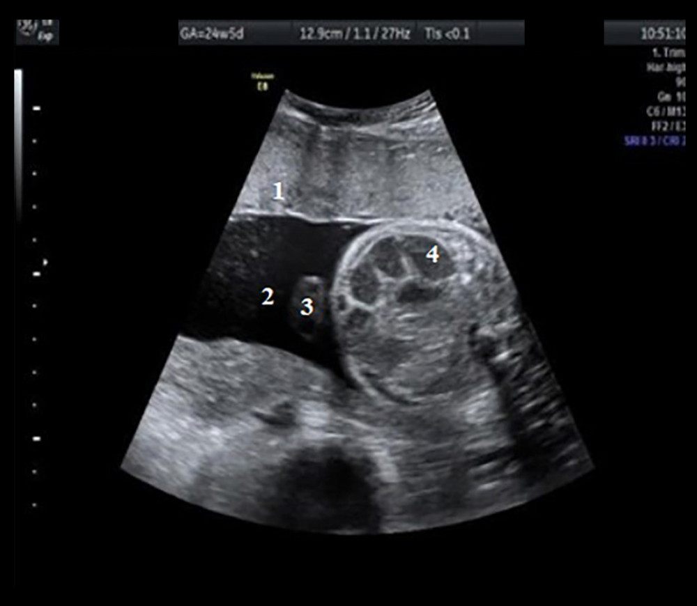 Transabdominal ultrasound of the fetus, aged 24 weeks and 4 days, showing a dilated loop with diameter >7 mm. Hyperechoic dilated intestinal loops are visible. 1, placenta; 2, amniotic fluid; 3, umbilical cord with 2 arteries and a vein; 4, dilated intestinal loops.