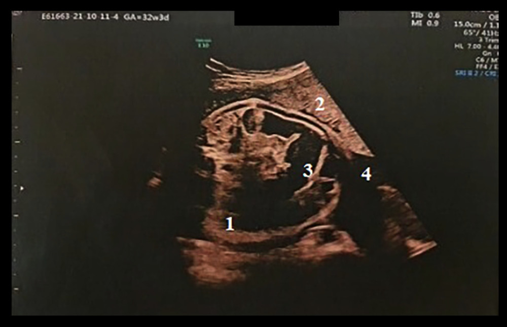 Transabdominal ultrasound of the fetus, aged 33 weeks, showing intestinal distension with hyperechoic debris in the intestinal lumen (succus-entericus) with continuous peristalsis, by real-time imaging examination. 1, section through the abdomen; 2, placenta; 3, dilated intestinal loop; 4, amniotic fluid.