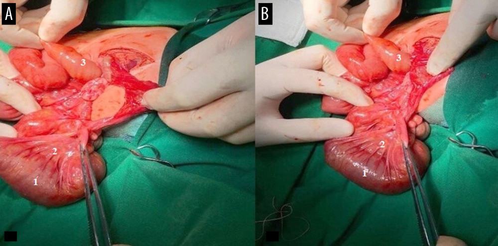 (A, B) Resection of the entire section of the small bowel in the newborn, aged 5 days. 1, ileum; 2, mesenteries; 3, jejunum.