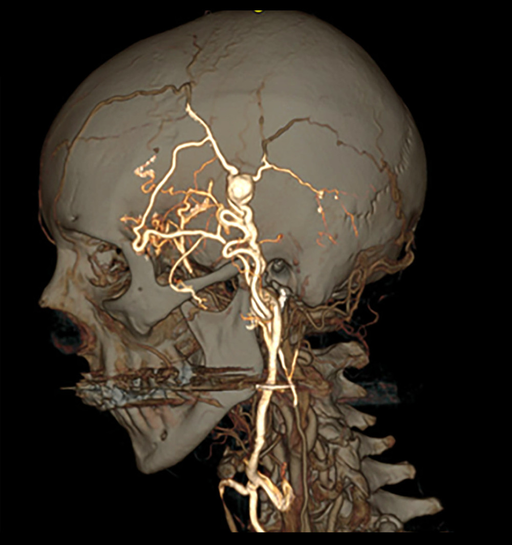 CTA image of 1.3×1.0 cm arteriovenous malformation nidus within the left temporal subcutaneous tissues with arterial feeders mainly from left external carotid artery and draining veins.