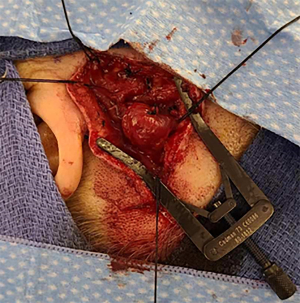 Intraoperative image of left-sided arteriovenous malformation of superficial temporal artery with inflow and outflow control, prior to complete resection.