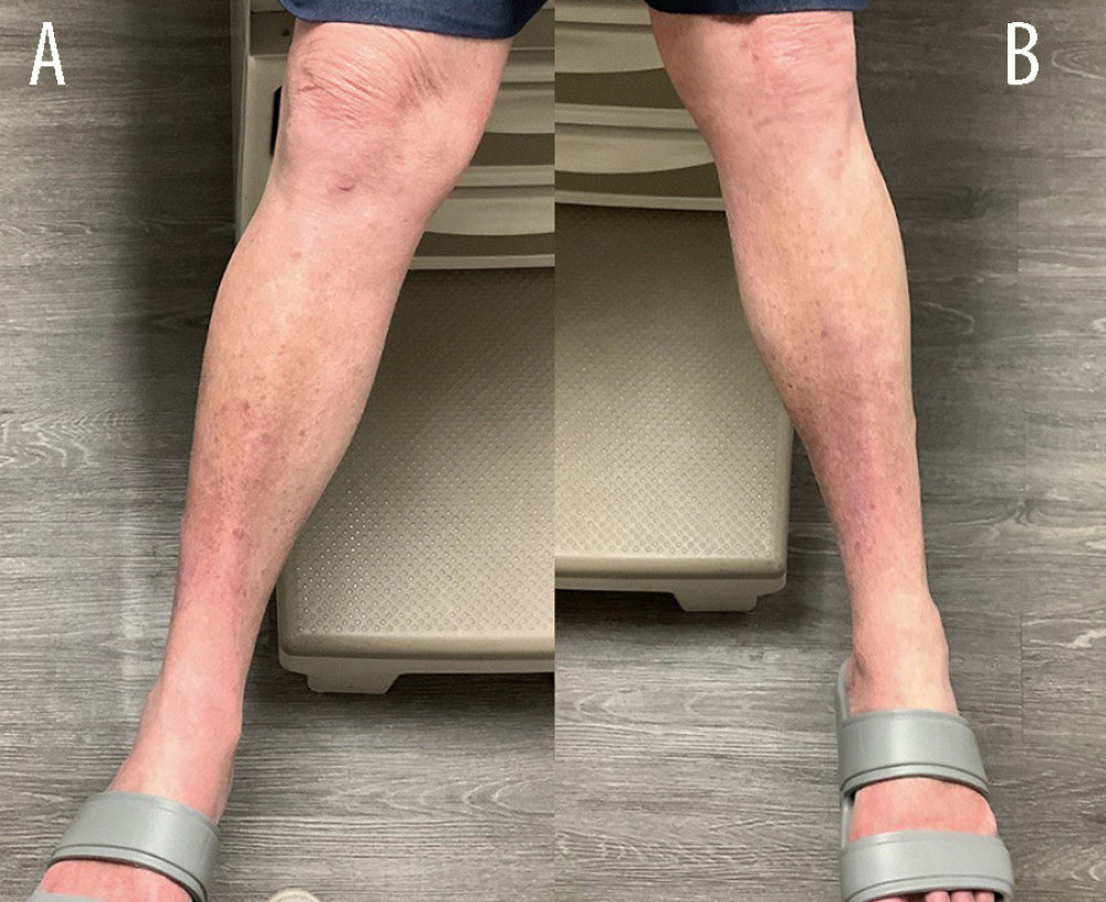 (A, B) Patient’s left and right lower extremities at initial visit to clinic showing reddish-brown macules and coalescing patches with studded petechiae on the bilateral distal anterior tibias, with concomitant venous stasis changes.