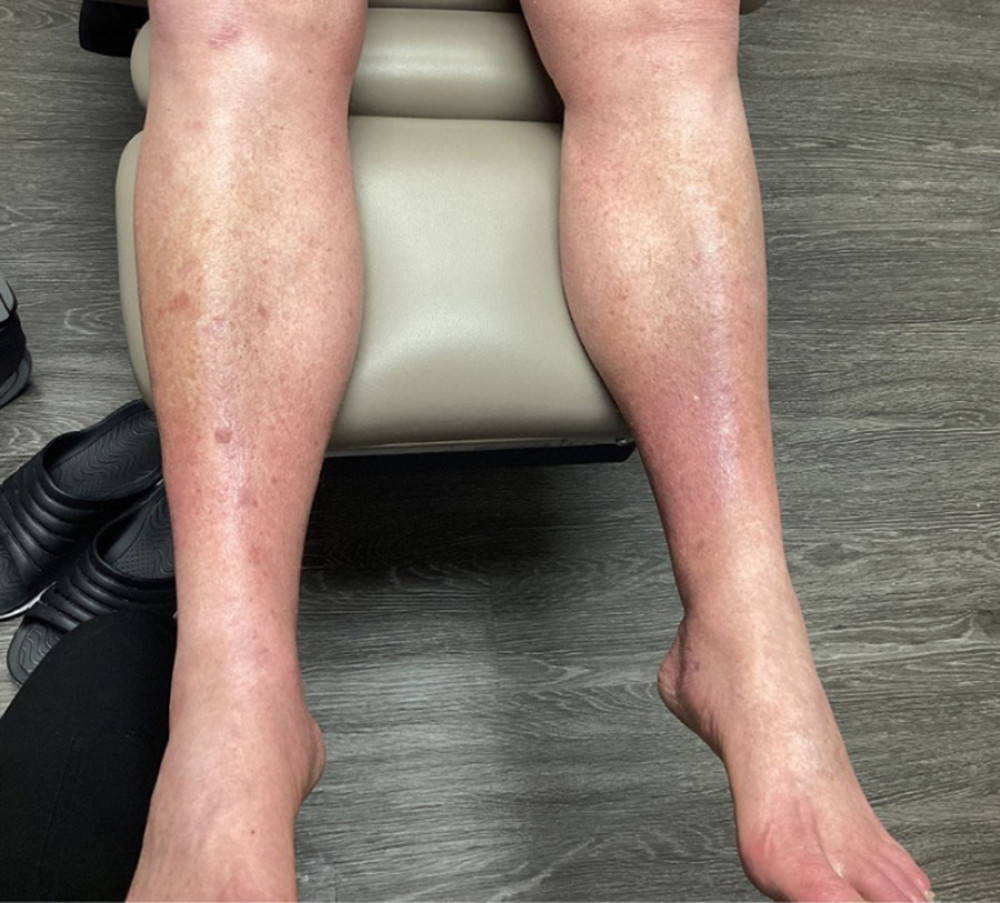 Patient’s lower extremities after 10 months of excimer laser therapy showing resolution of pigmented purpuric dermatosis and slight improvement of venous stasis change.