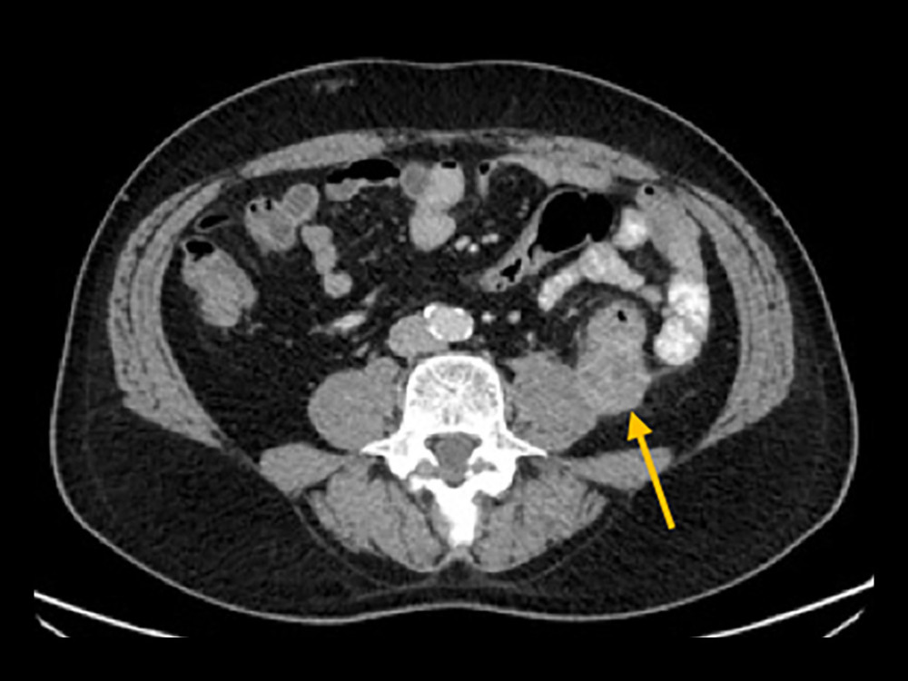 Peritoneal metastasis in a 58-year-old man. Heterogeneously-enhancing left flank nodule (2.3 cm, arrow) abutting the descending colon anteriorly and left psoas muscle medially, suspicious for peritoneal metastasis.
