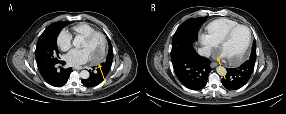 (A) Intracardiac metastasis in a 58-year-old man. Hypodense lesion (HU 45–50) involving the left ventricle (arrow, left image) and atrial appendage (HU 40–45) (arrow, right image) along the endocardium abutting the myocardium. (B) Intracardiac metastasis in a 58-year-old man. Inter-atrial septum nodular hypodense lesion extending into bilateral atria.