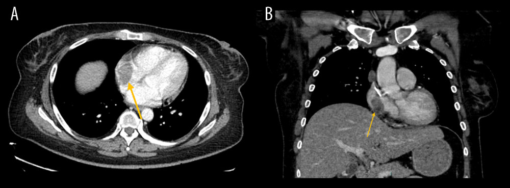 (A, B) Companion case: right atrial thrombus induced by implanted venous access port insertion in a 41-year-old woman. Hypodense eccentric lesion (arrows) arising at the venous port tip within the right atrium abutting the right atrial wall.